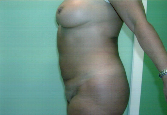 liposcultura addome