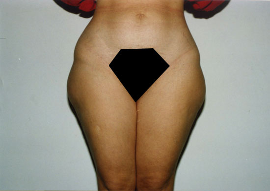liposcultura coscie
