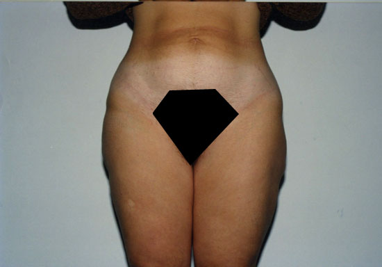 liposcultura coscie