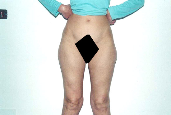 liposcultura coscie