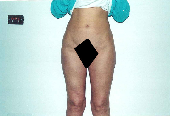 liposcultura coscie