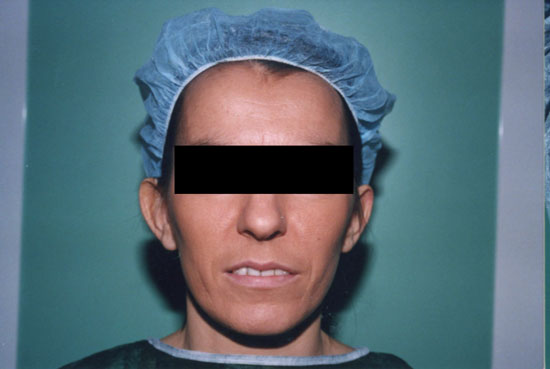 otoplastica 
