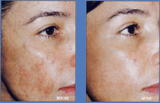 laser fraxel interventi al viso