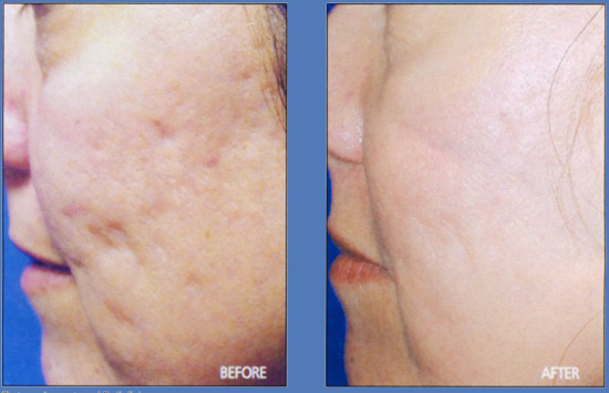 laser fraxel interventi al viso