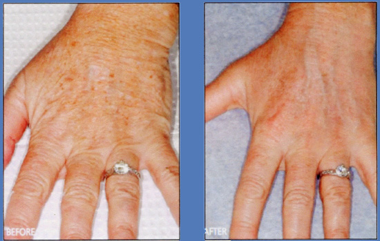 interventi di laser fraxel su mani